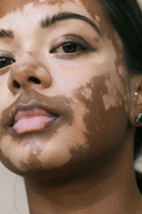 Vitiligo (pronounced: (vih-tih-LY-go) is a loss of skin pigment that causes white spots or patches to appear on the skin. No one knows exactly why this happens, but it affects people of all races, many of them kids and teens. Because vitiligo affects a person's appearance, it can be upsetting.